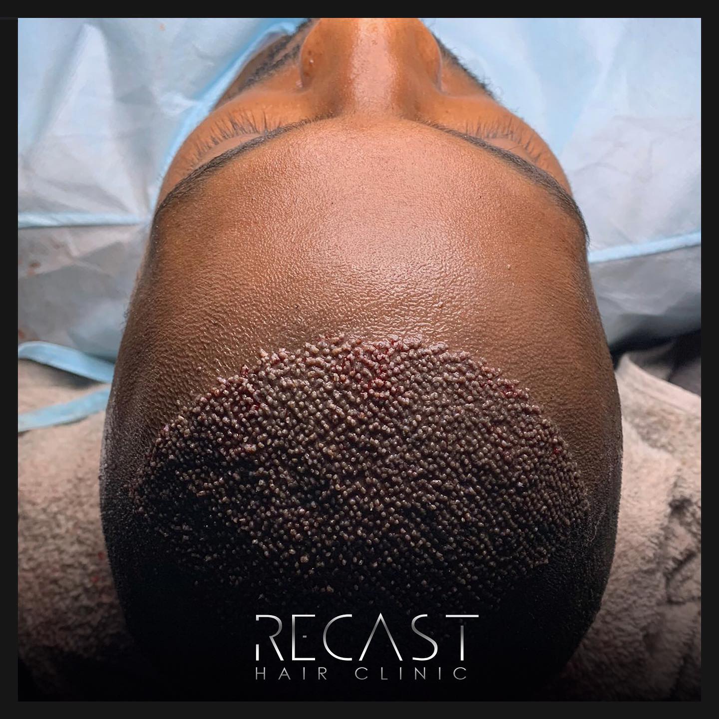 Afro Haartransplantation