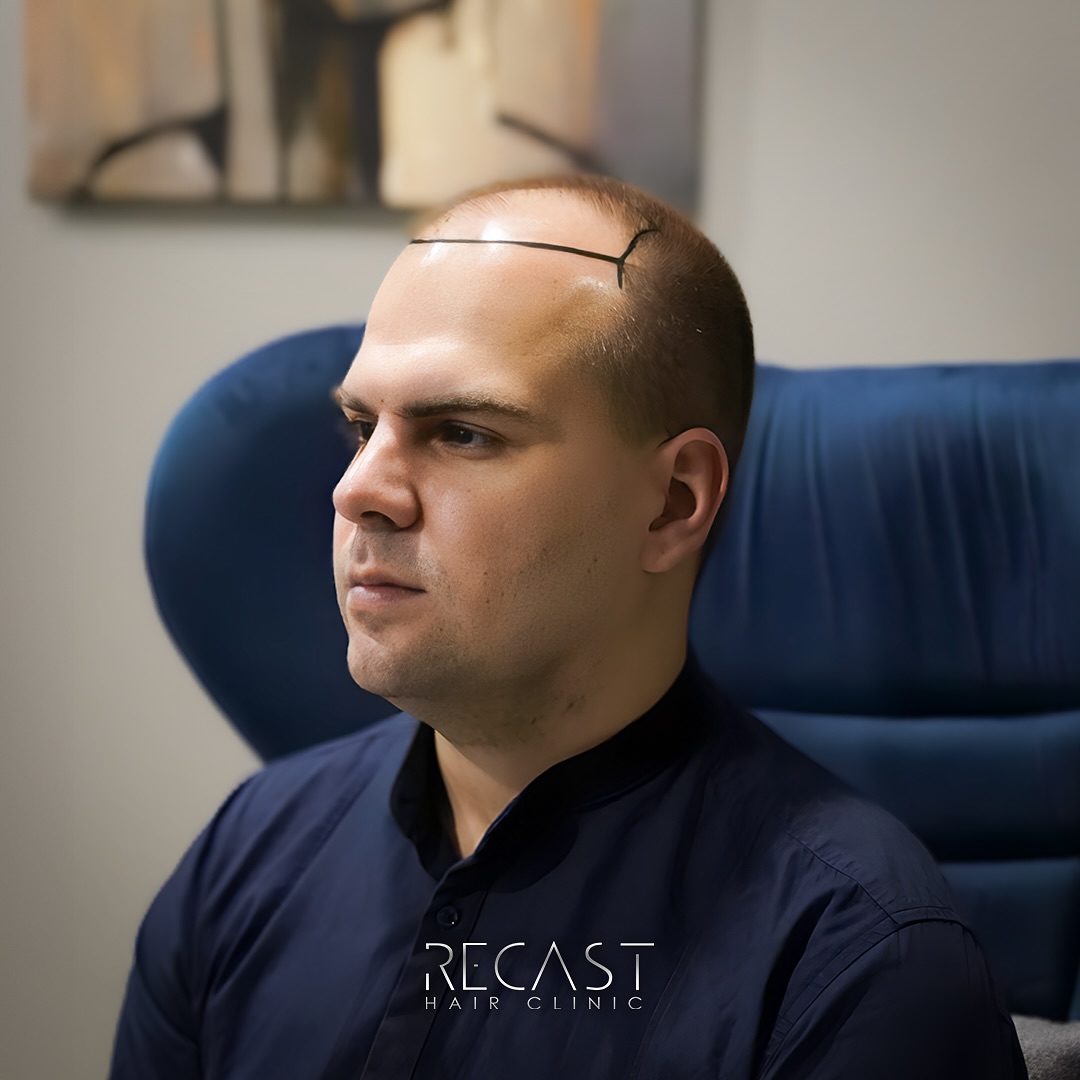 Haartransplantation mit Rasur