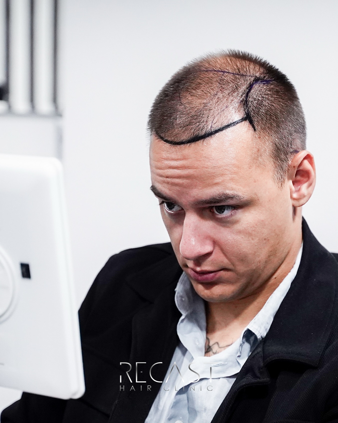 Haartransplantation ohne Rasur