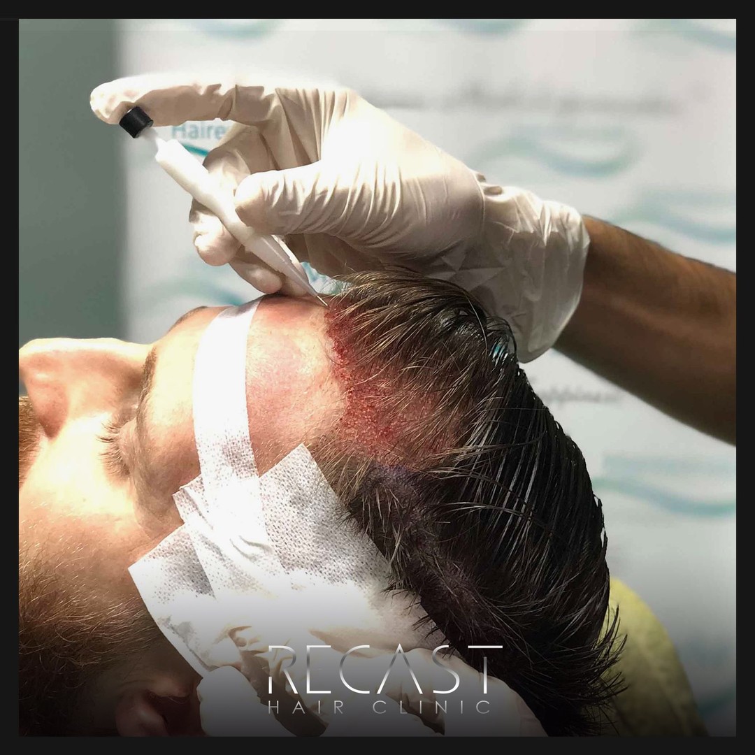 Schlafen Haartransplantation