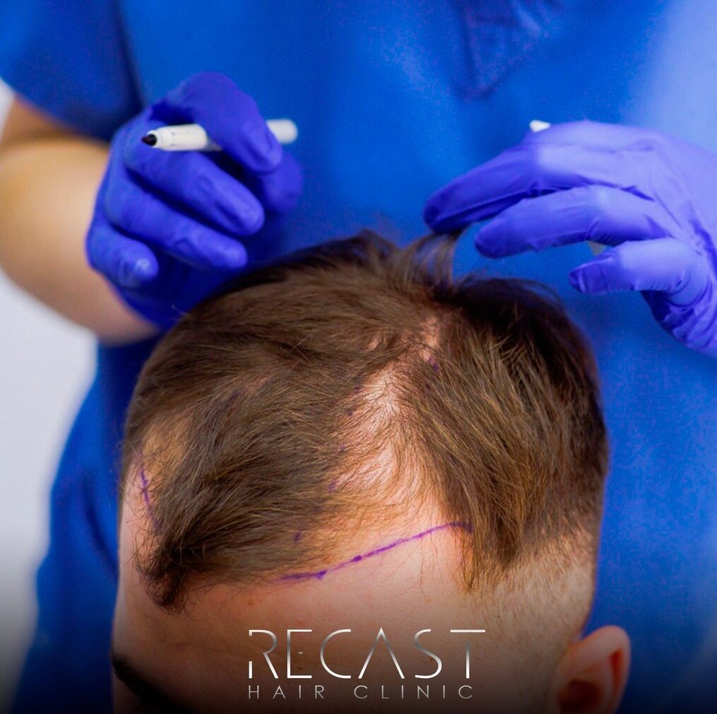 Medizinische Haarausfallbehandlung