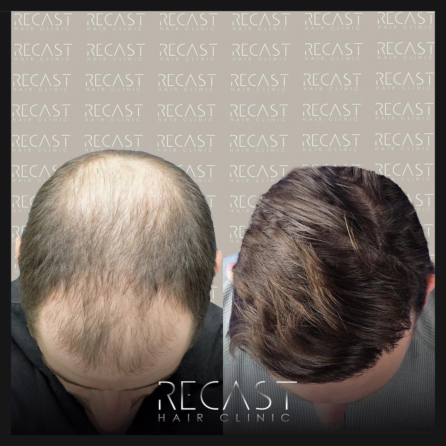 Haarlinie Transplantation