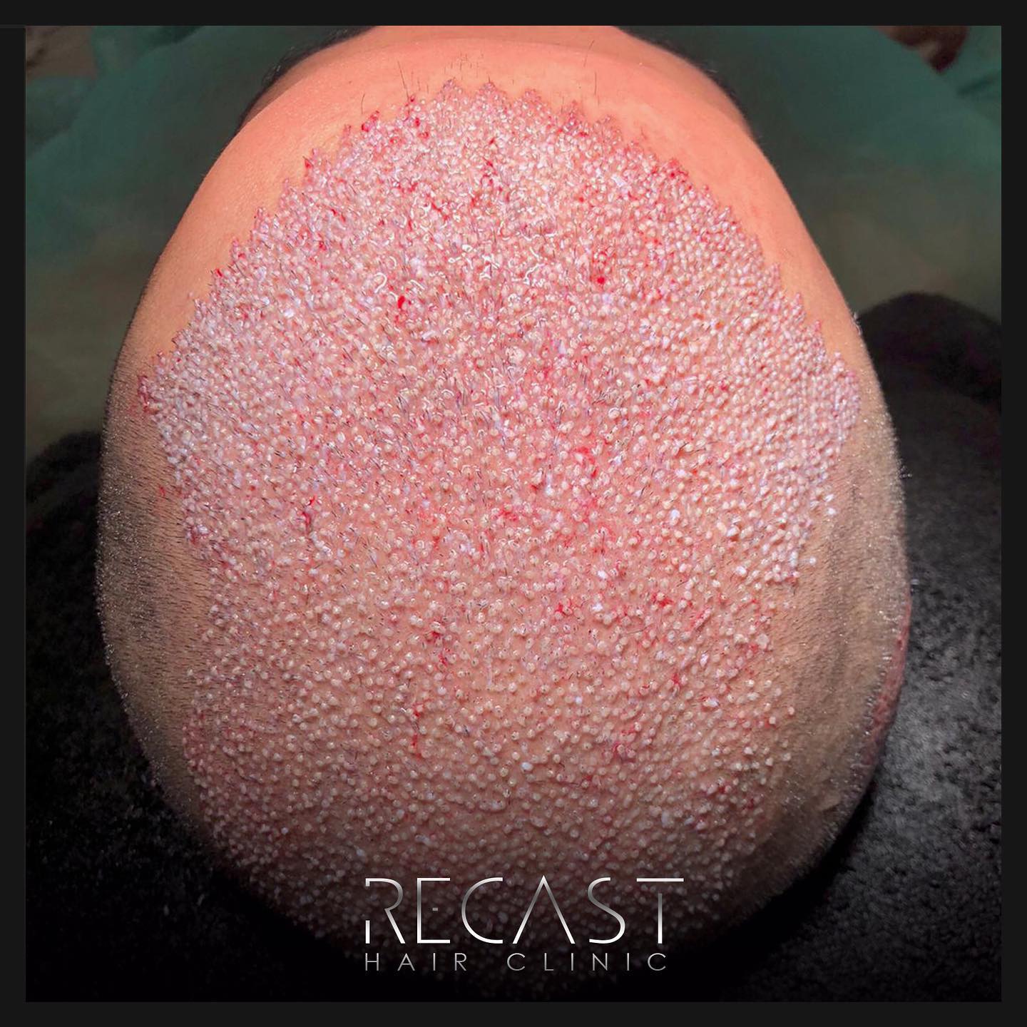 Vertex Haartransplantation