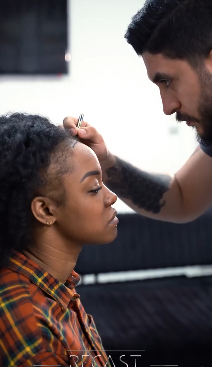 Haartransplantation bei Frauen