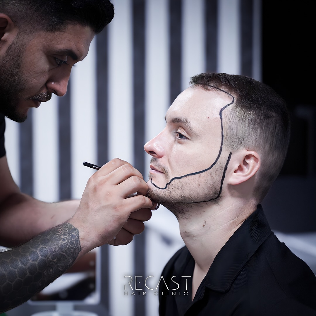 Haartransplantation Ratgeber - Wissen und Tipps