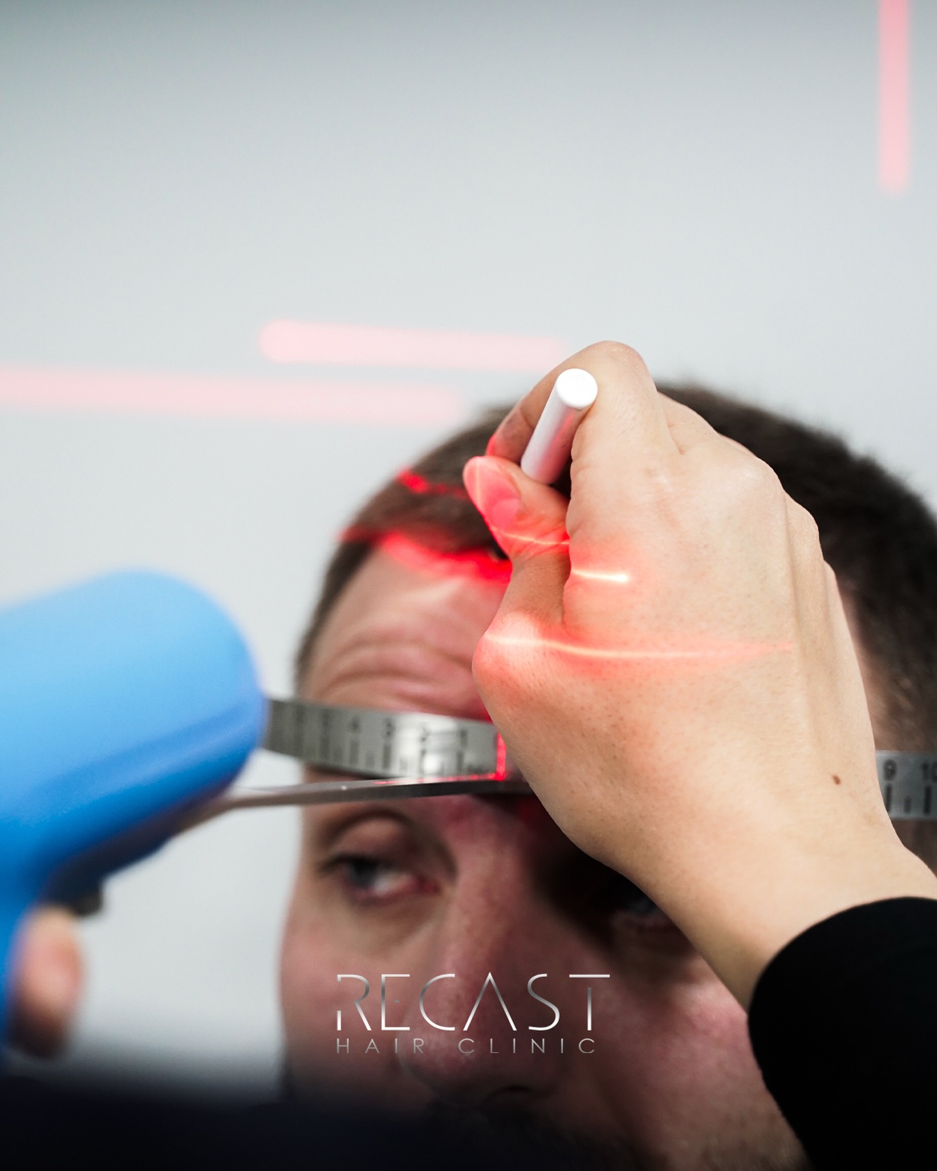 Augenbrauentransplantation